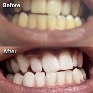 A Bright Smile, in just 30 Minutes with Dr Dent Whitening Strips